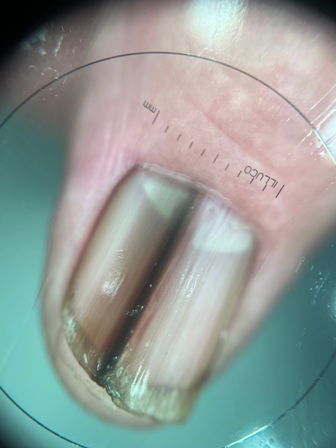 ¿Línea oscura en la uña? Podría ser una señal de cáncer y debes consultar a tiempo - Red Informativa